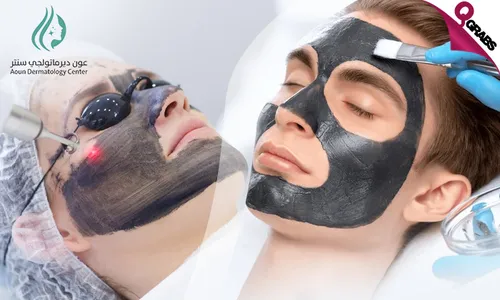 Carbon Laser for Face, Hair & Dark Areas!
